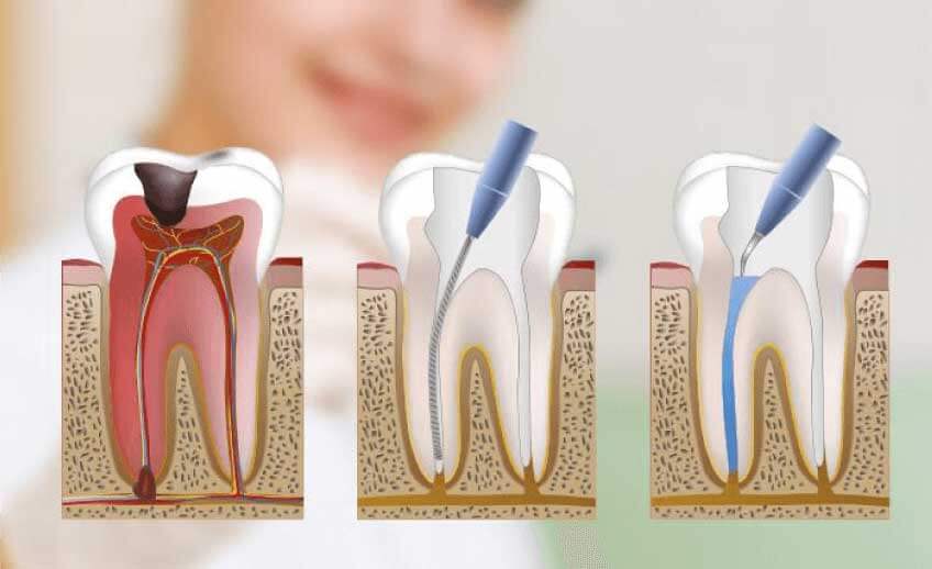 endodoncia Sagunt Dental