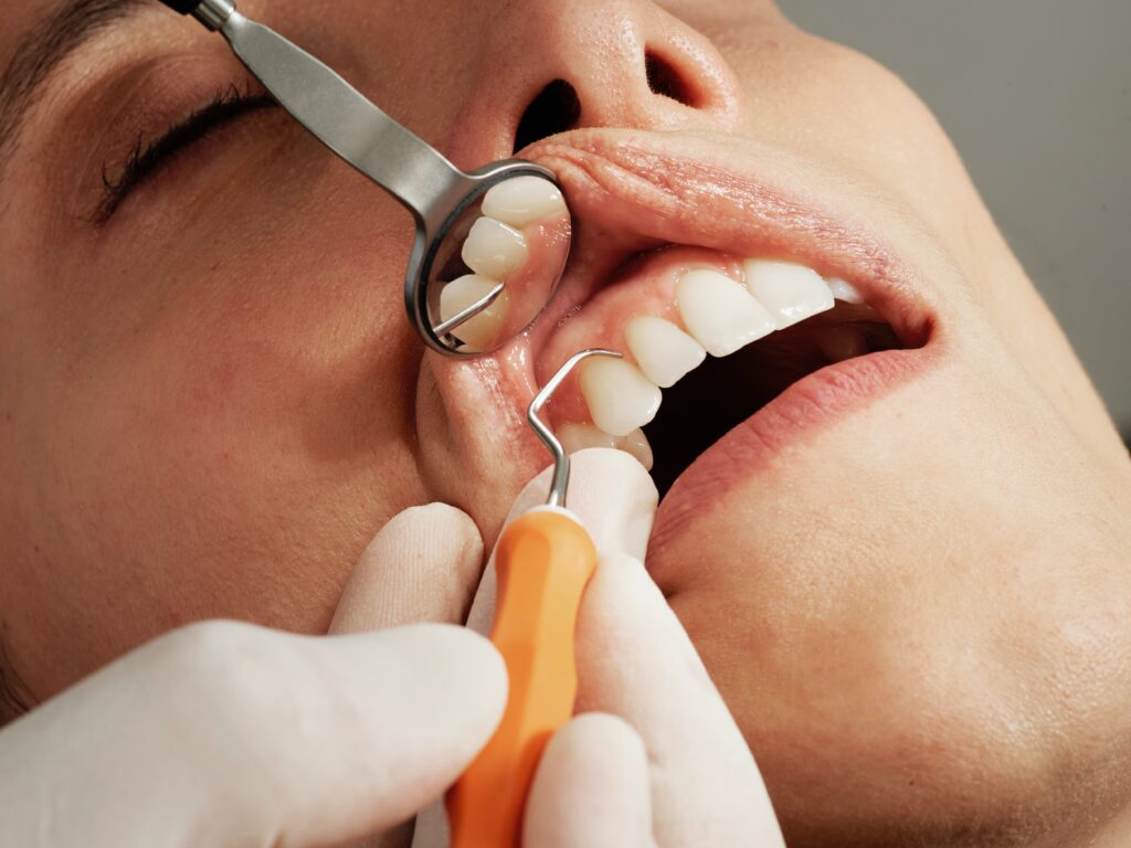 limpieza dental Sagunto