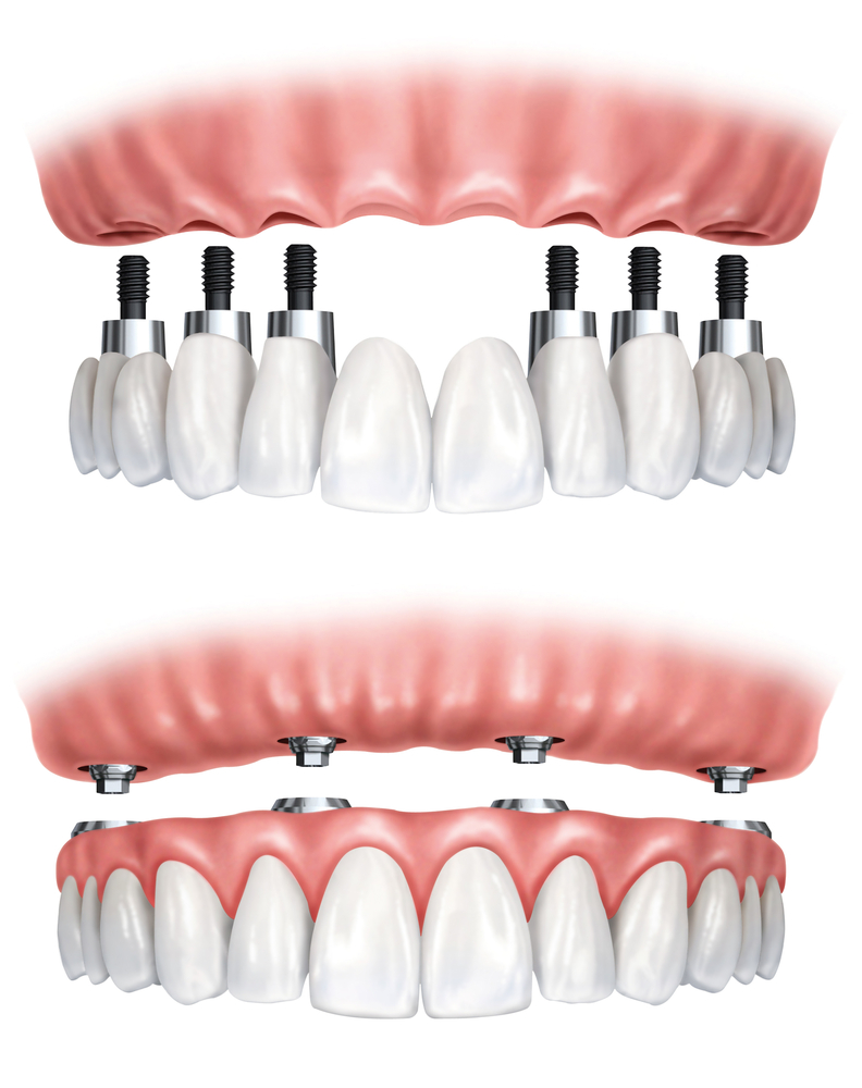 implantes dentales Sagunto