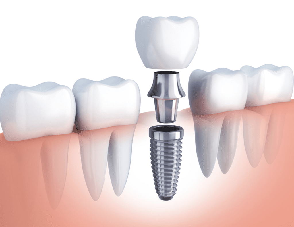 prótesis dentales fijas sagunto