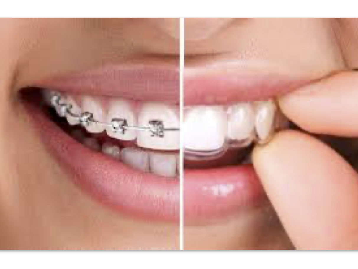 ortodoncia invisible Sagunt Dental