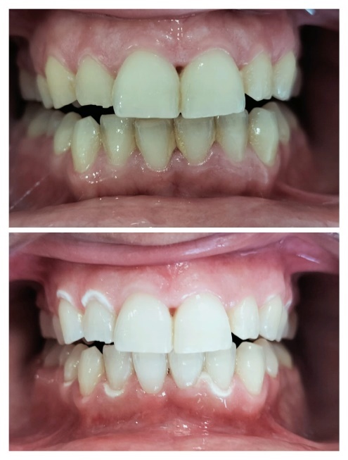 Casos de blanqueamiento dental en Sagunt Dental