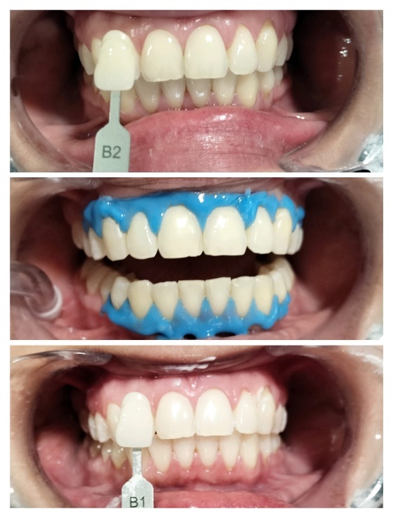 Casos de blanqueamiento dental en Sagunt Dental